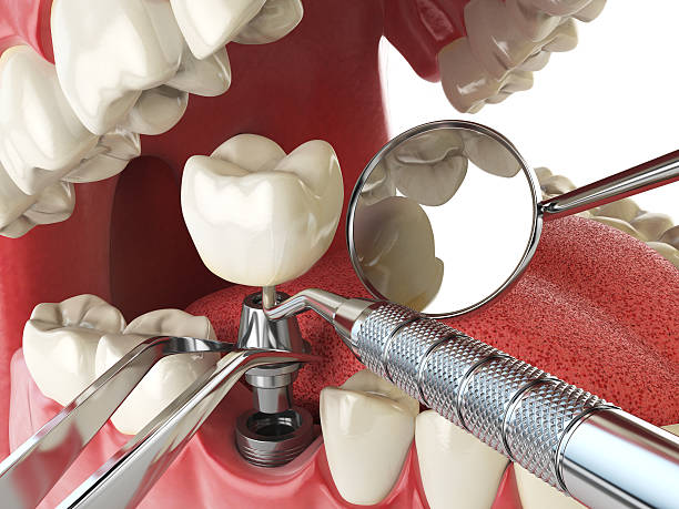 Best Urgent Care for Lost Fillings or Crowns in Hazel Park, MI